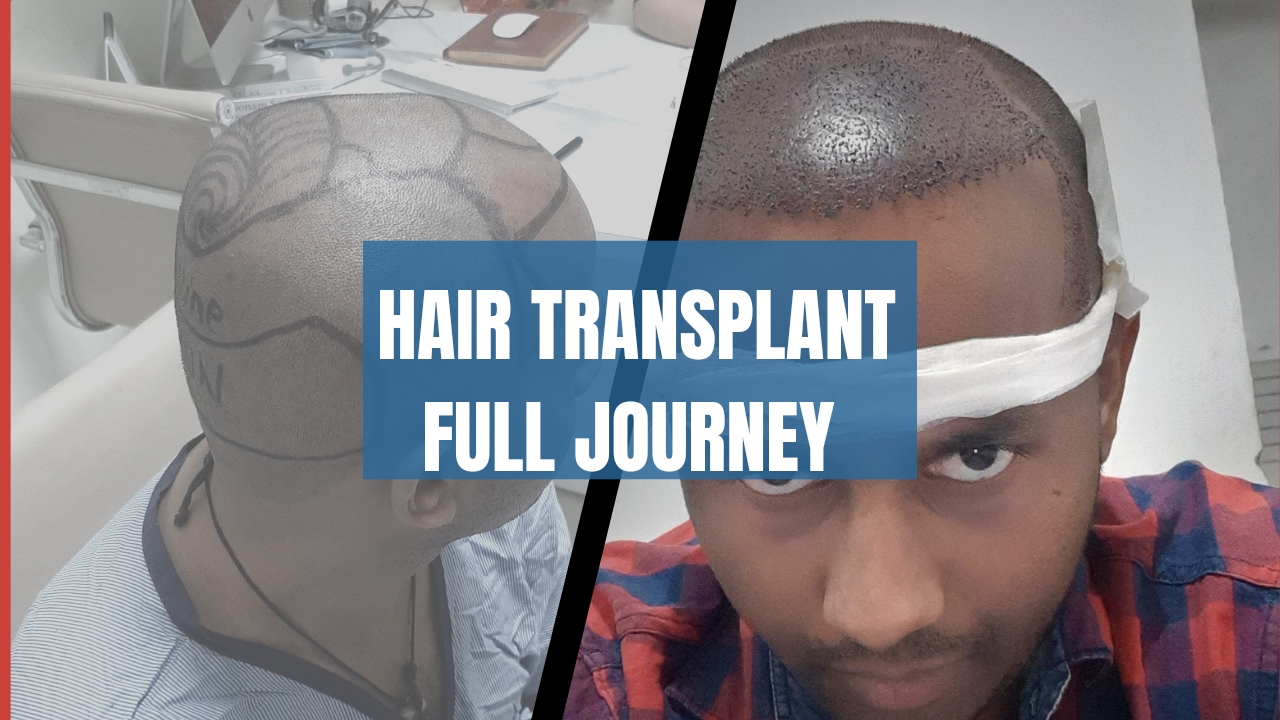 1st day hair transplant