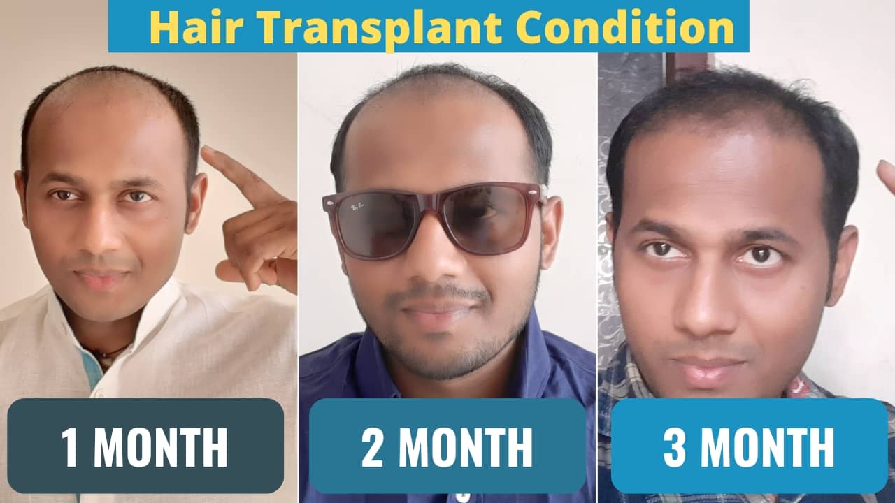 3 Months Hair Transplant Condition